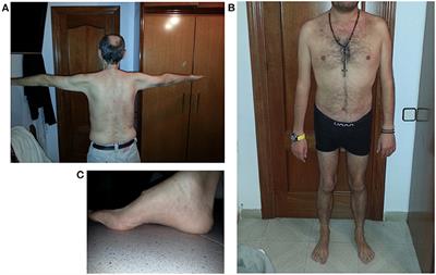 LGMD D2 TNPO3-Related: From Clinical Spectrum to Pathogenetic Mechanism